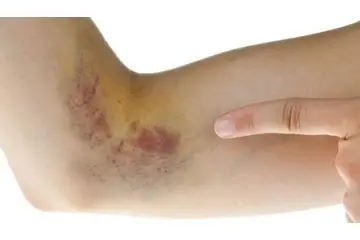 Karaciğer Yağlanması Ciltte Belirtileri Nelerdir?